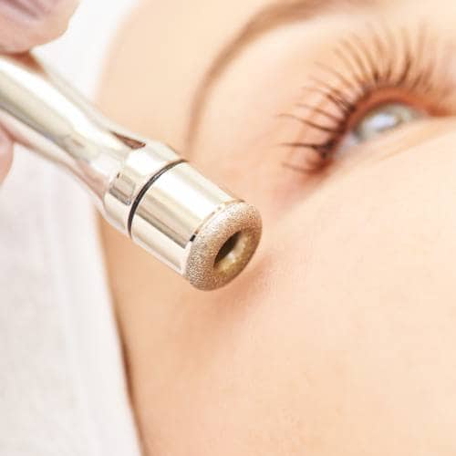 Microdermabrasion